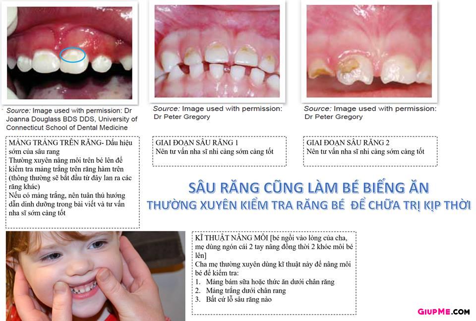 Nguyên tắc phòng ngừa sâu răng cho trẻ?